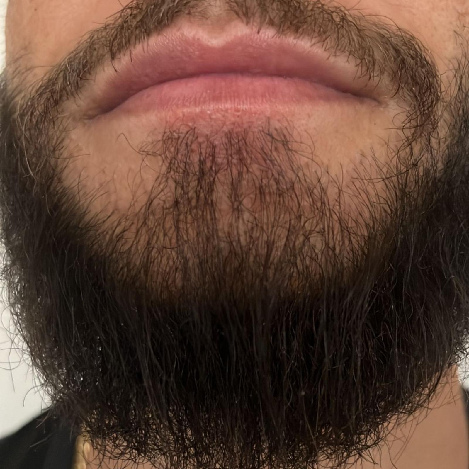 beard transplant