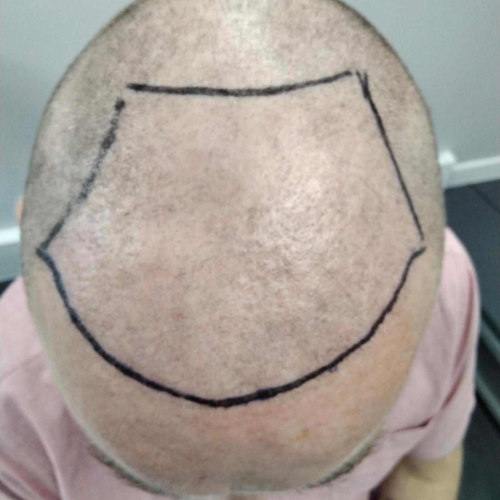 fue hair transplant