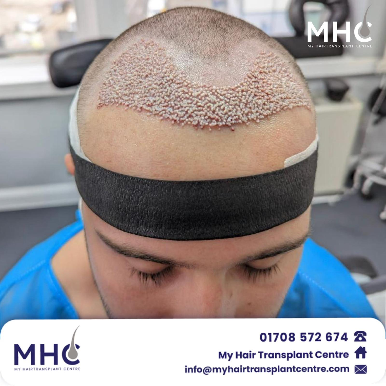 fue hair transplant