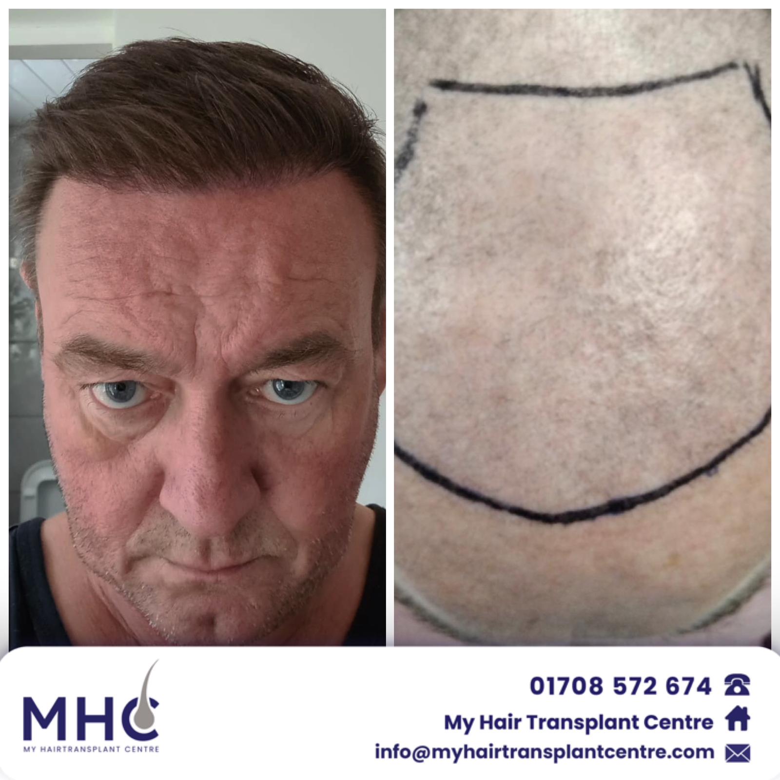 hair transplant clinic